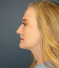 Feel Beautiful - Face, Neck, Eyes, Laser - After Photo